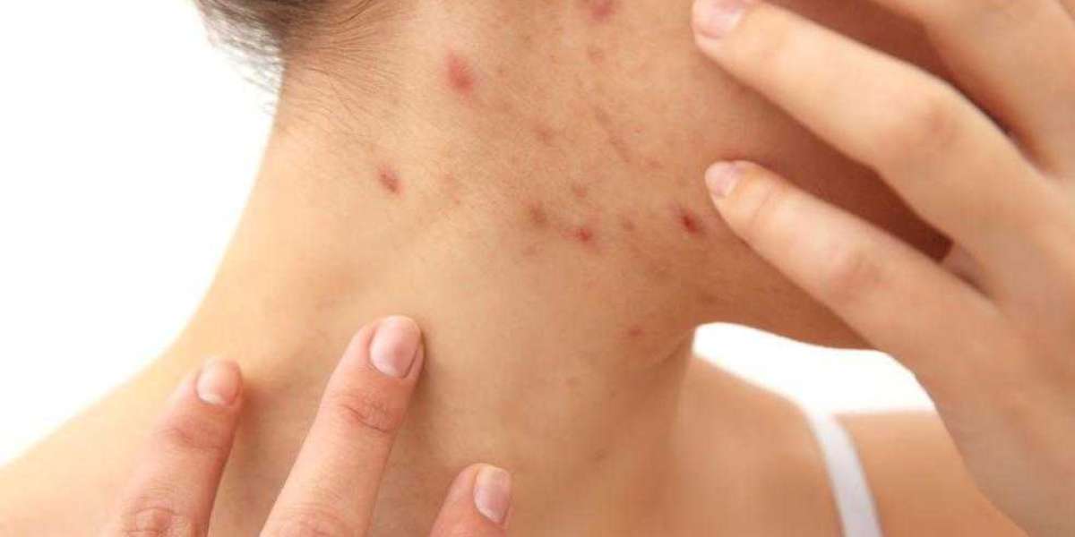 How do you treat scabies on your skin?