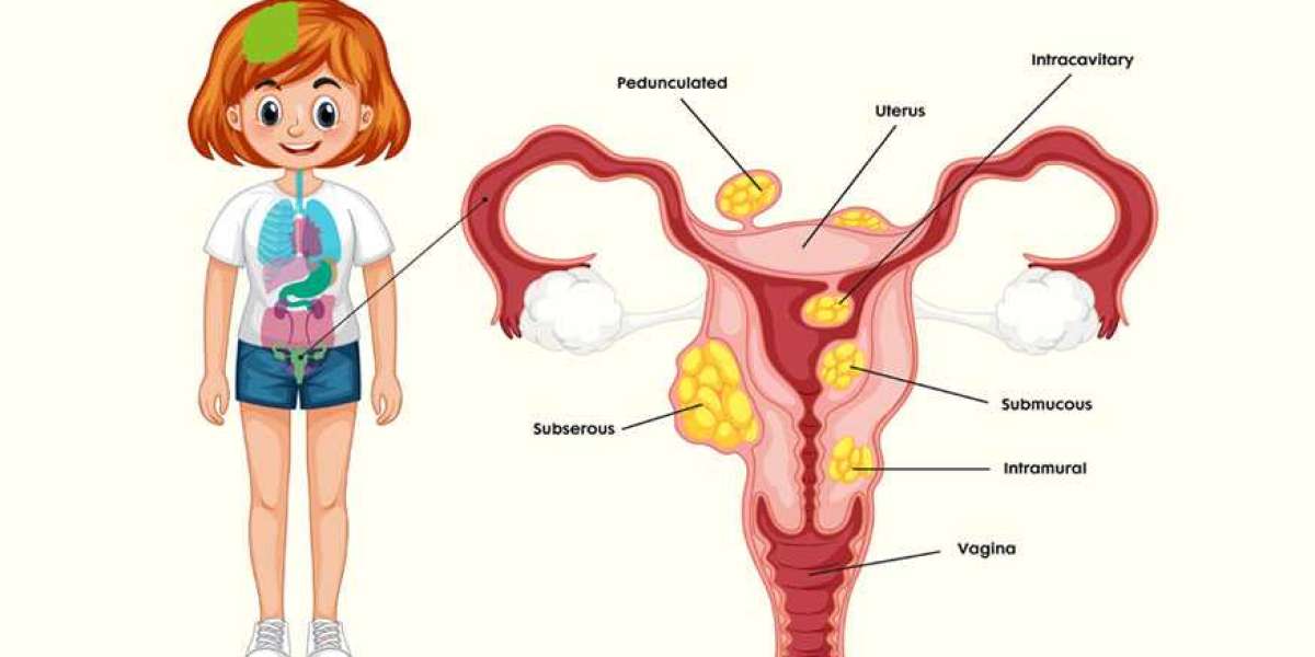 Comprehensive Guide to Uterine Fibroids Treatment: Options and Insights by Flowcare